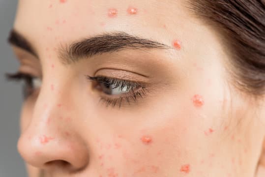 What is Acne
