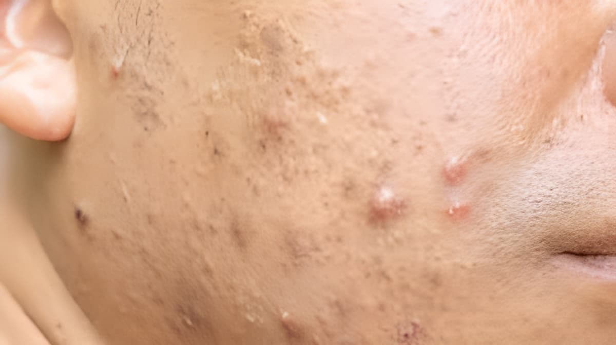 Homeopathy for Acne