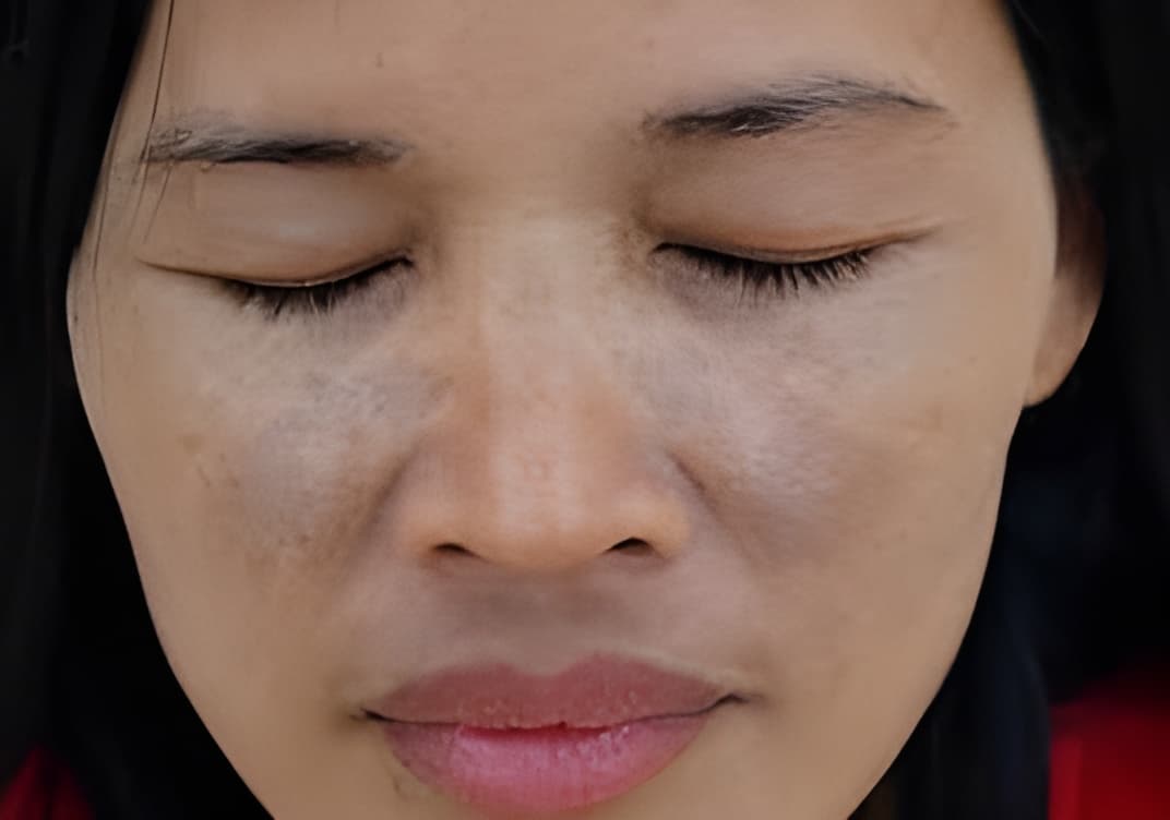 FAQ about Face Discoloration