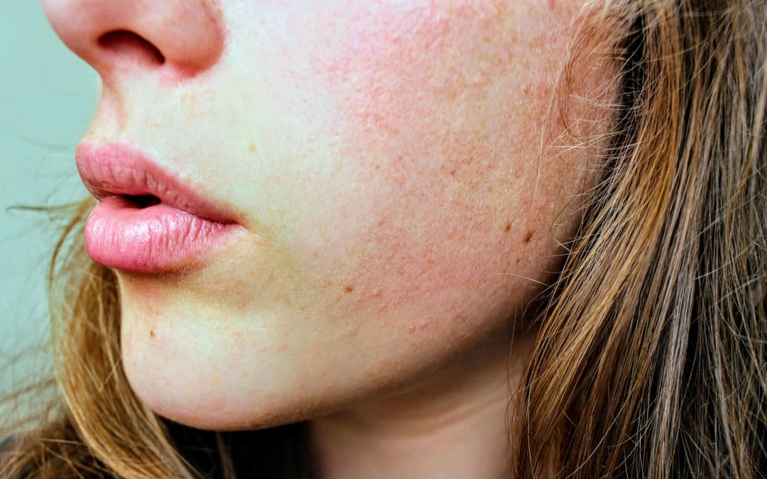 Homeopathy Treatment