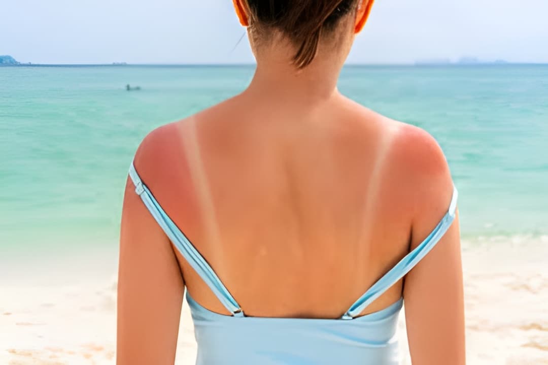 Sunburn Homeopathy