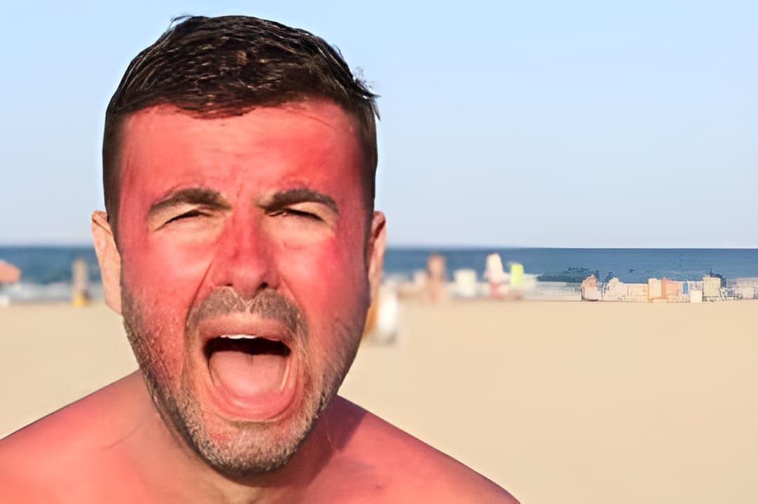 FAQs on Sunburn