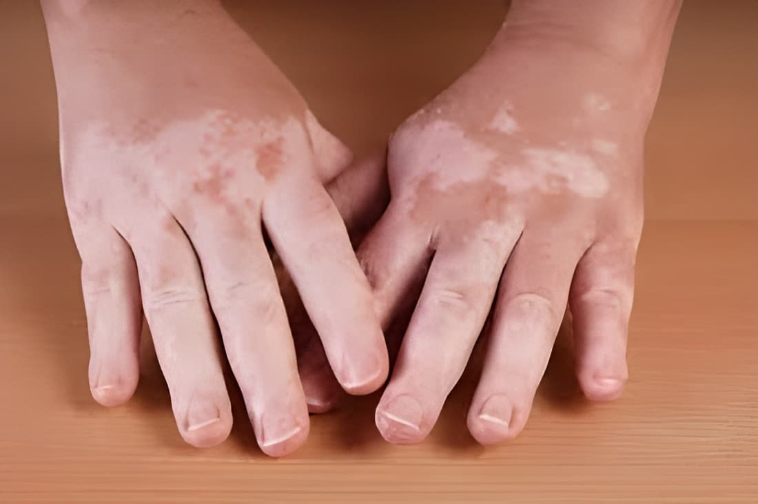 Vitiligo example