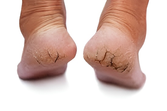 Homeopathy for Cracked Heels