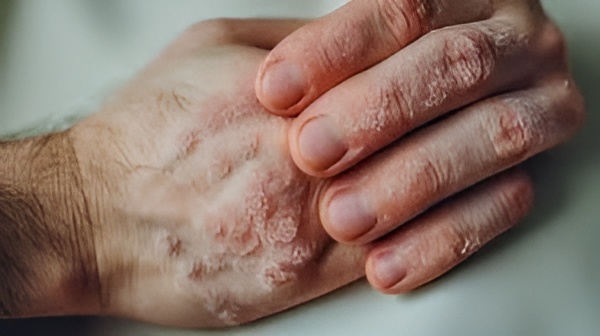 Homeopathy for Dermatitis