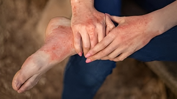 Dermatitis FAQs