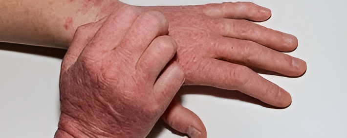 Homeopathy care for eczema