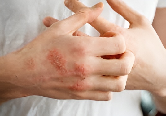 FAQs about eczema treatment