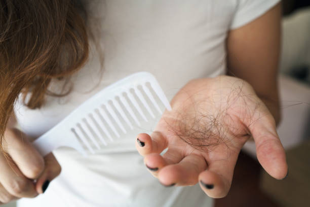 Homeopathy treatment for hair loss