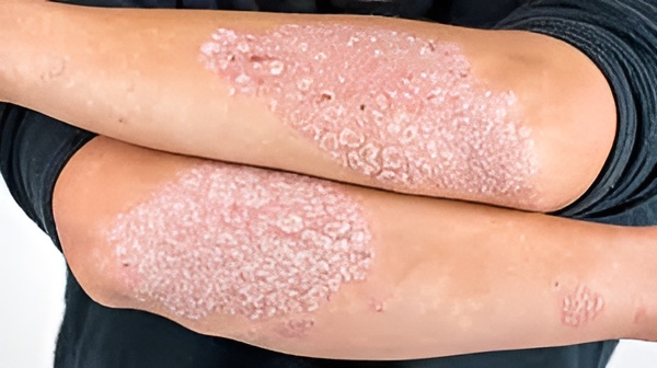 Homeopathy Benefits for Psoriasis