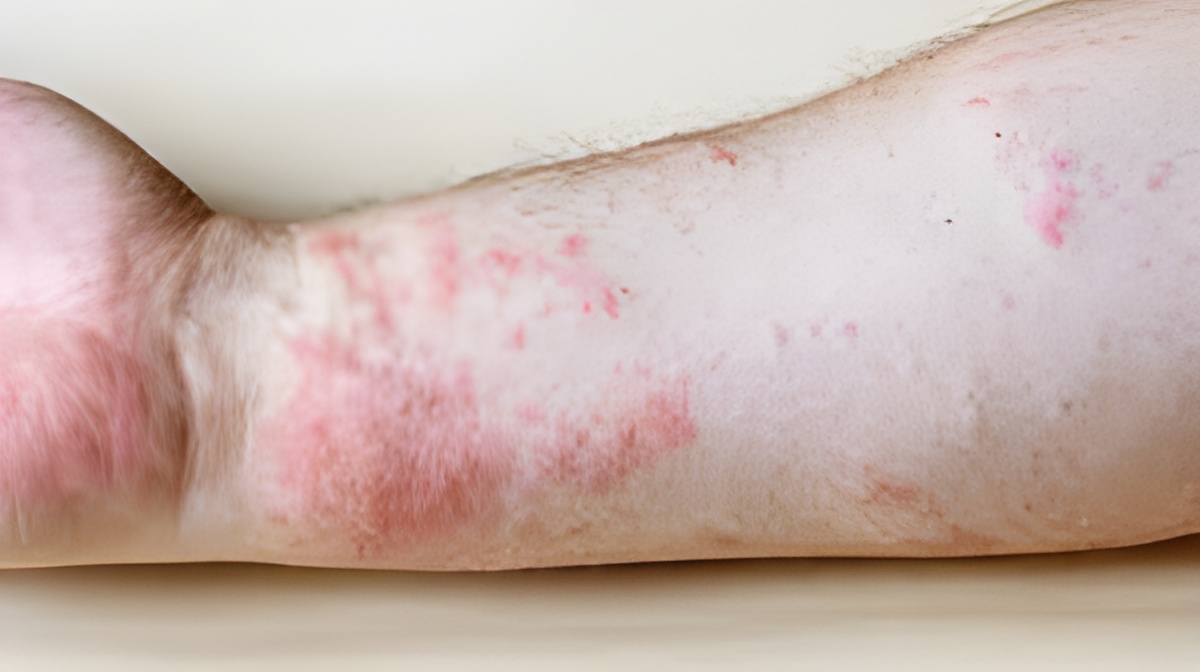 Homeopathy Skin Rash Treatment