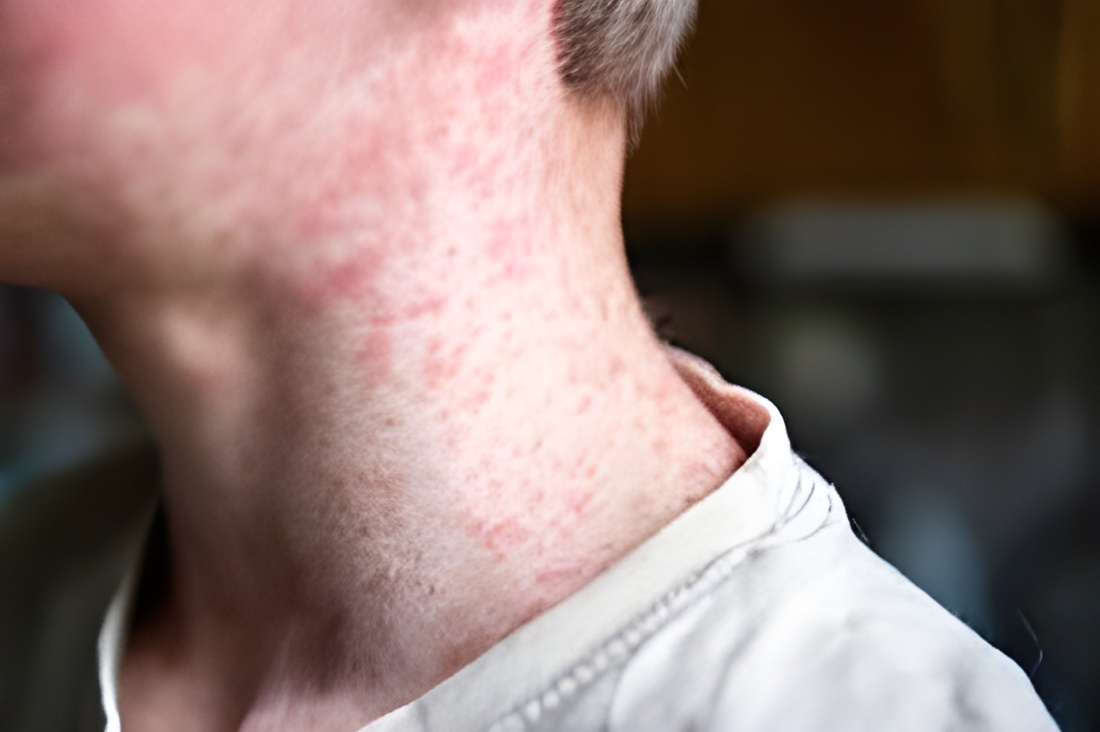 FAQs about skin rashes