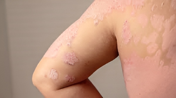 FAQs about Psoriasis Treatment