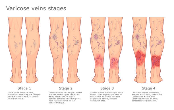 Homeopathy treatment for varicose veins