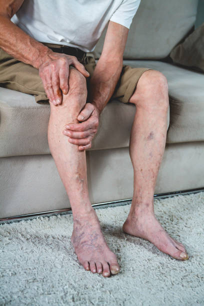 FAQs about Varicose Veins Homeopathy Treatment
