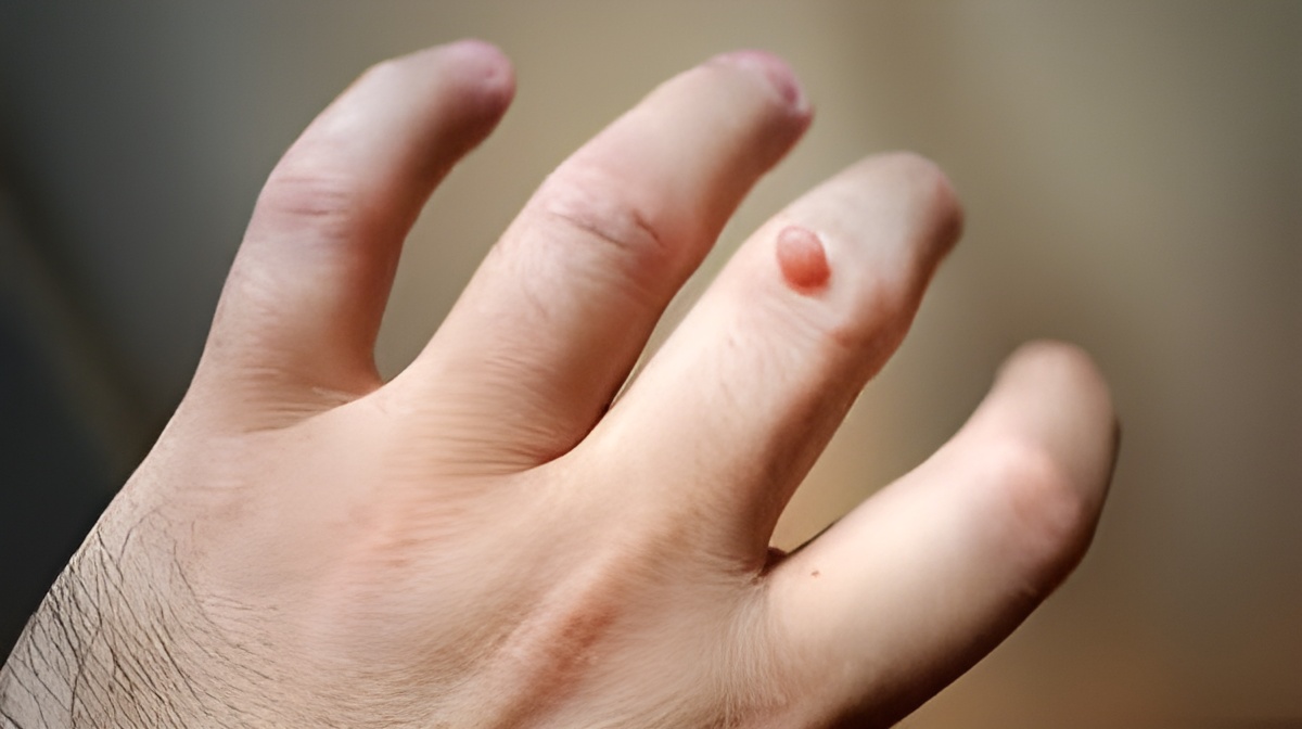 FAQs about warts treatment